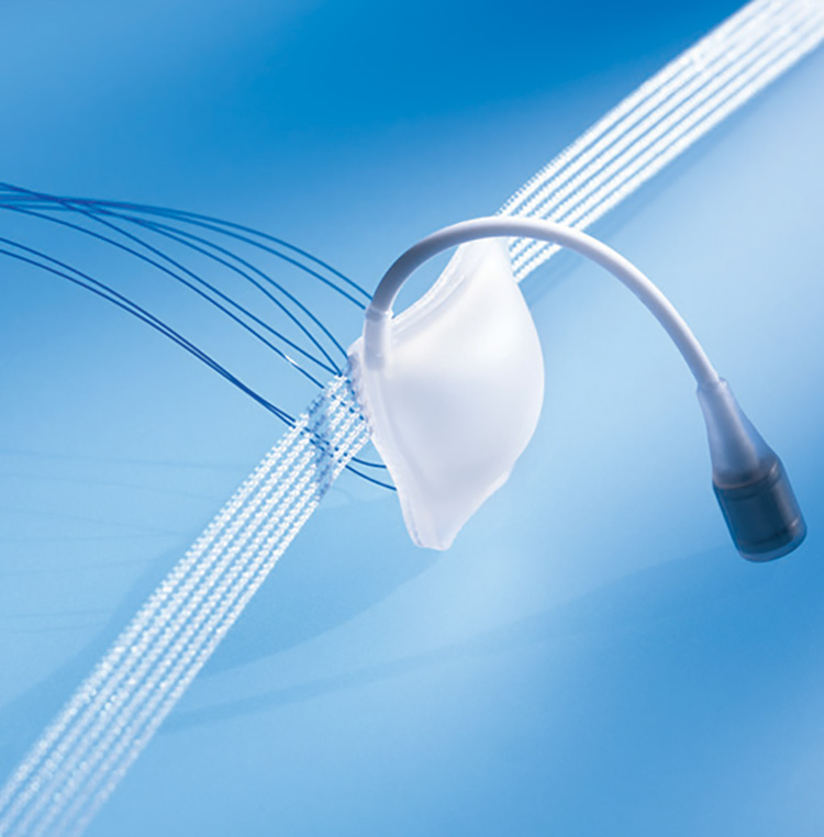 IMPLANTABLE MALE URINARY INCONTINENCE SYSTEM
