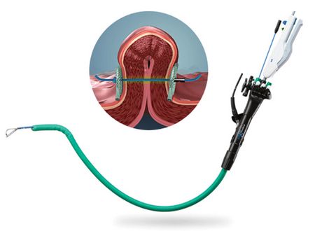 ENDOSCOPIC GASTRIC PLICATION WITH POSE® SYSTEM