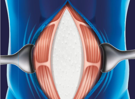 Abdominal biological matrix