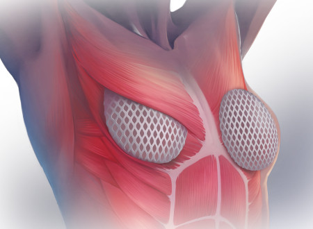 Breast reconstruction matrix