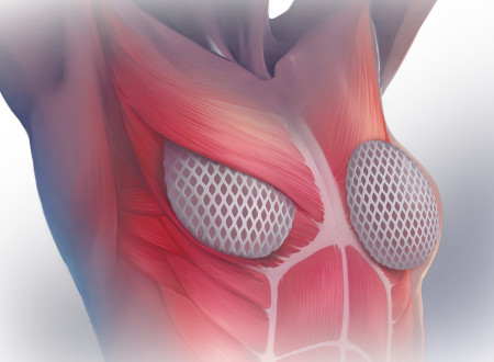 Matrice per ricostruzione mammaria